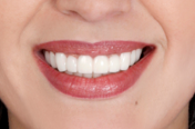 Snap-On Smile teeth after